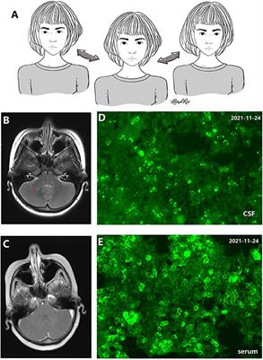 Acute Cerebellitis Associated With Anti-homer 3 Antibodies: A Rare Case Report and Literature Review